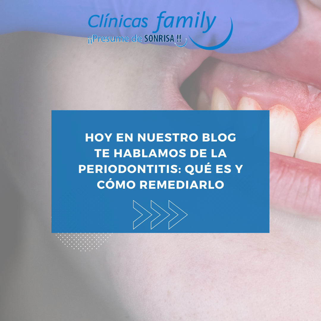 ¿QUÉ ES LA PERIODONTITIS?